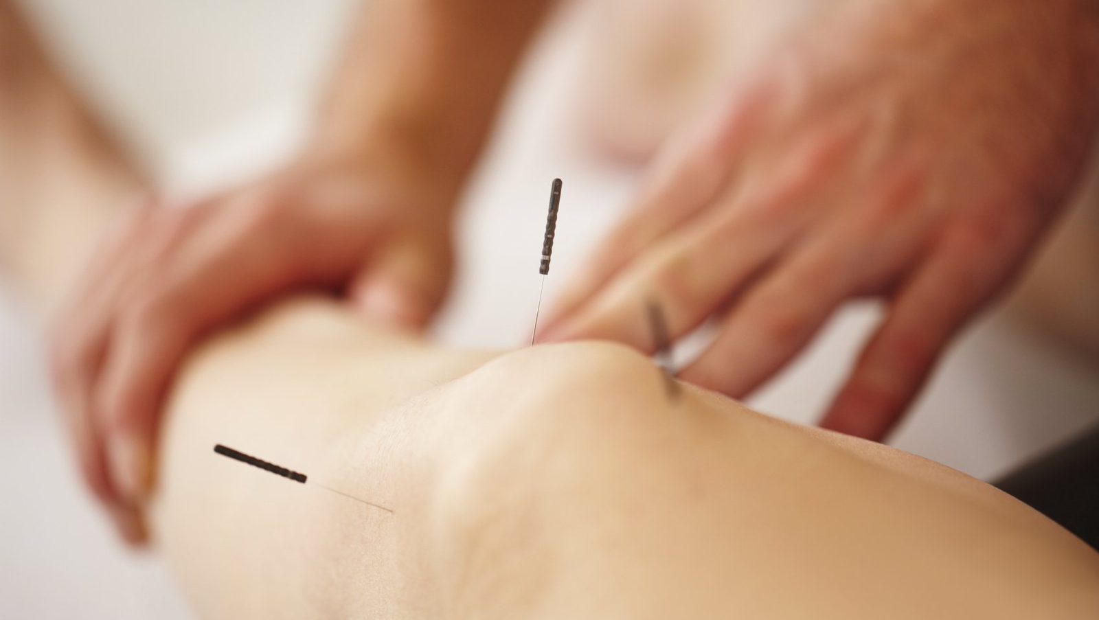 Akupunkturbehandlung am Knie