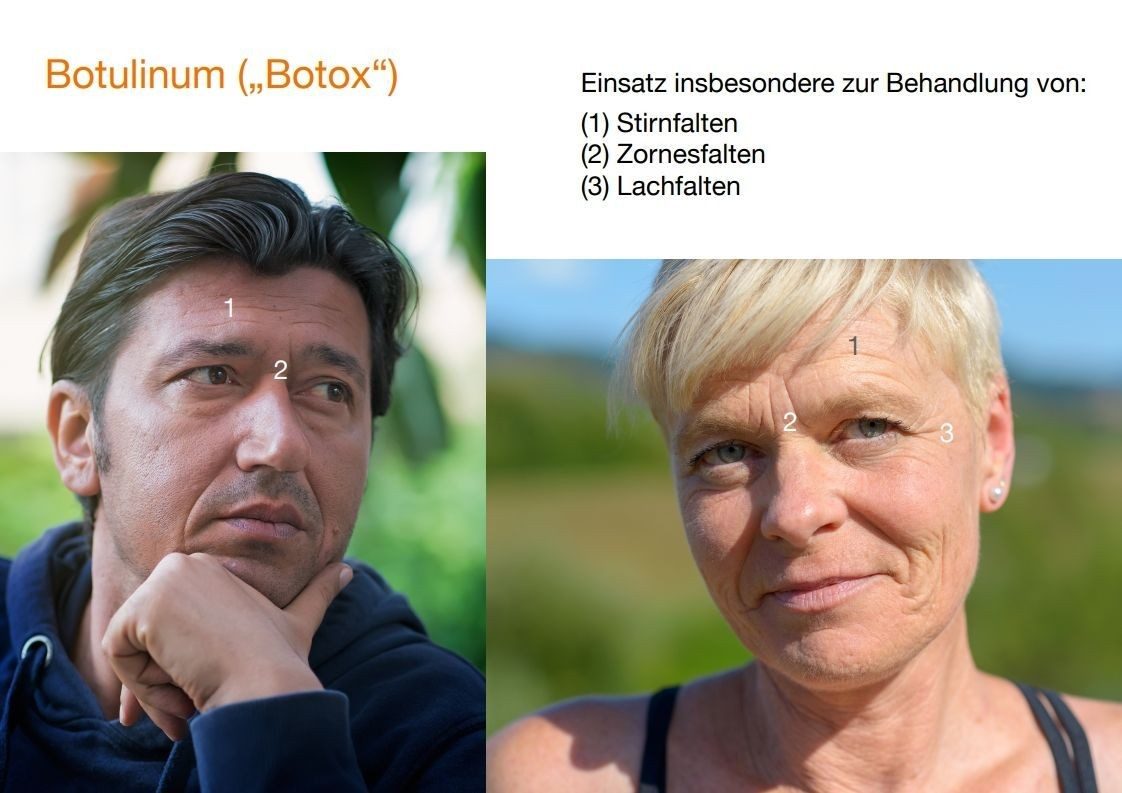 Übersichtsgrafik: Botulinum-Einsatzbereiche im Gesicht – Stirnfalten, Zornesfalten, Lachfalten