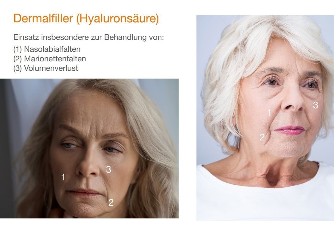 Übersichtsgrafik: Dermalfiller-Einsatzbereiche – Nasolabialfalten, Marionettenfalten, Volumenverlust