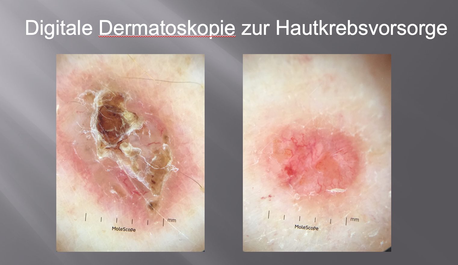 Digitale Dermatoskopie zur Hautkrebsvorsorge